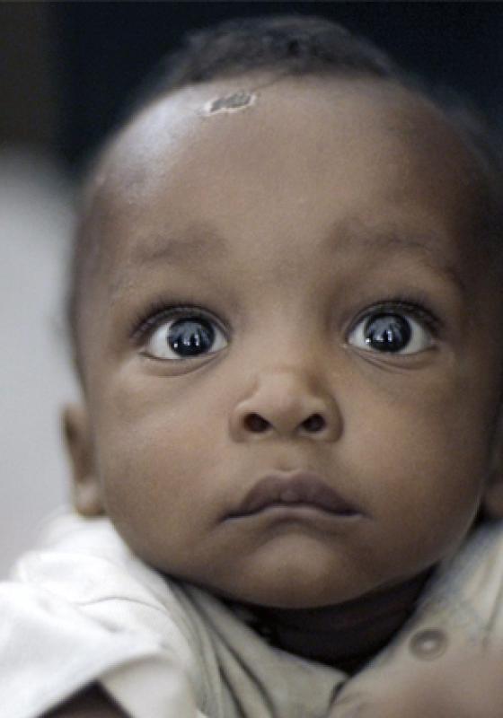 niño con malaria niño con malaria