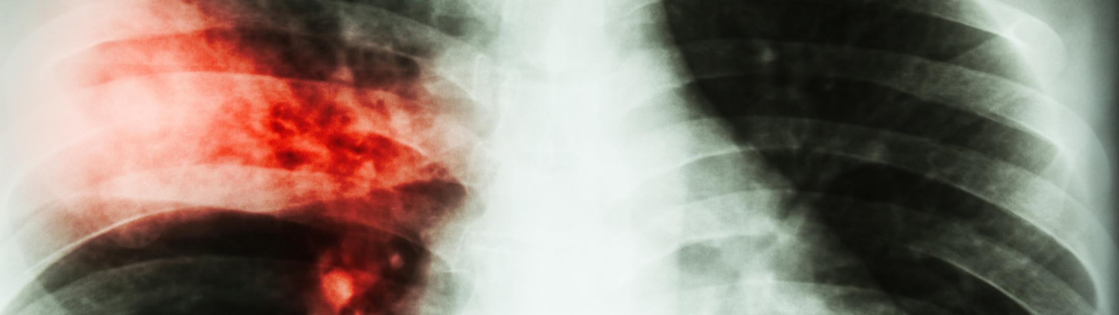 Aislamiento en tuberculosis: por qué es importante