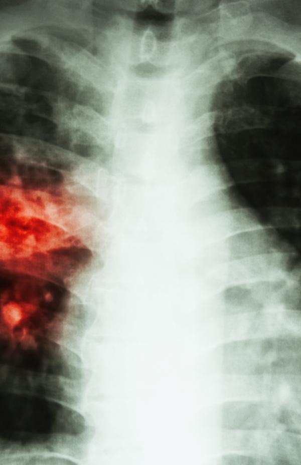 Aislamiento en tuberculosis: por qué es importante