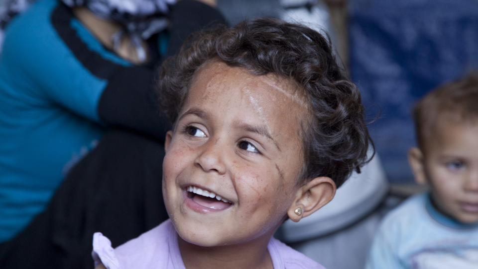 Las heridas de la guerra en el rostro de la pequeña Shahad 