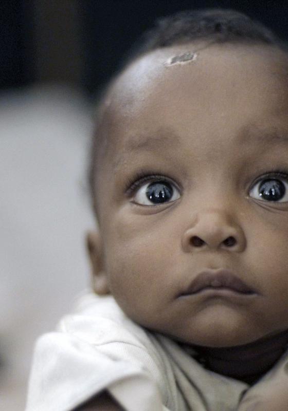 Niño africano con Malaria